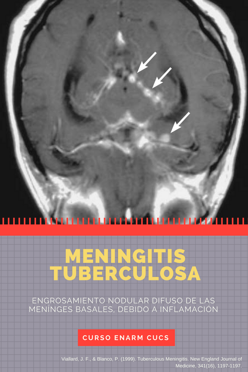 Meningitis_Tuberculosa.png