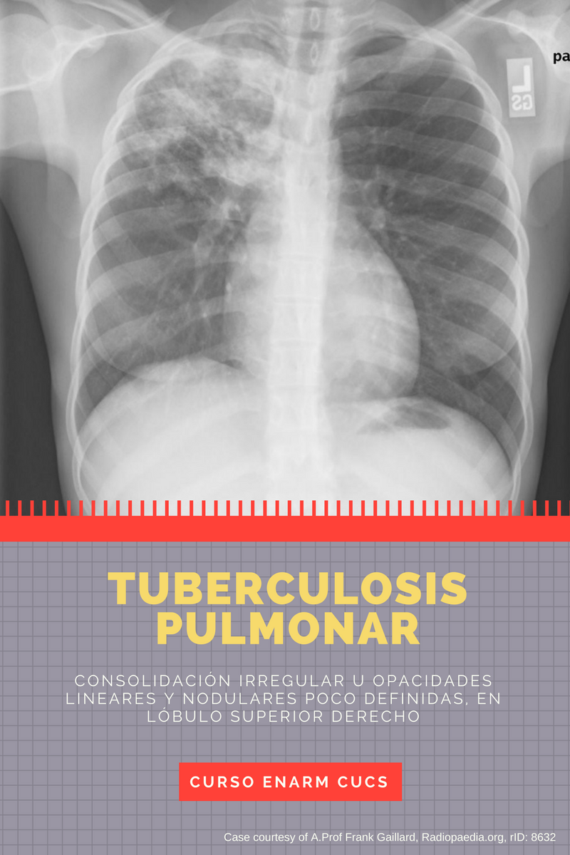 Tuberculosispulmonar.png